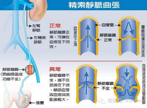 關(guān)于2021年征兵精索靜脈曲張標(biāo)準(zhǔn)的探討，2021年征兵精索靜脈曲張標(biāo)準(zhǔn)深度解析