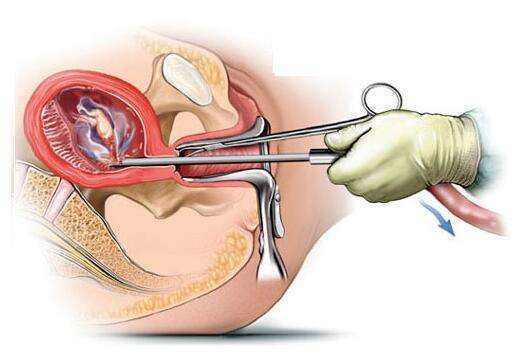 無痛人流術(shù)后醒來的疼痛感受解析，無痛人流術(shù)后醒來的疼痛感受解析及應(yīng)對建議