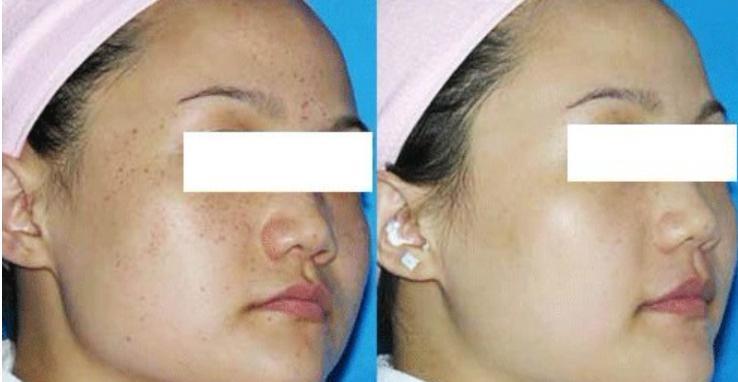 激光祛斑后需要注意的五大事項(xiàng)，激光祛斑后的五大注意事項(xiàng)詳解