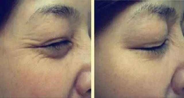 肉毒素除皺的副作用深度解析，肉毒素除皺副作用深度解析