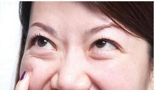 消除眼袋