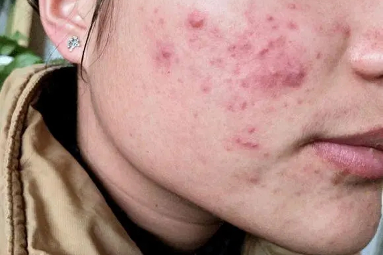 臉上痤瘡的癥狀和圖片，全面解析與識別指南，全面解析與識別，臉上痤瘡的癥狀和圖片指南