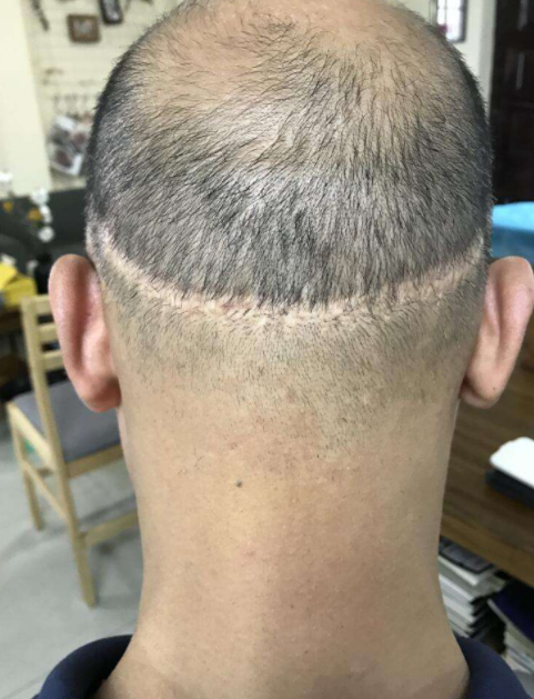 植發(fā)效果的持久性，能否長期維持與多種因素相關(guān)，植發(fā)效果的持久性與多種因素關(guān)聯(lián)，長期維持探討