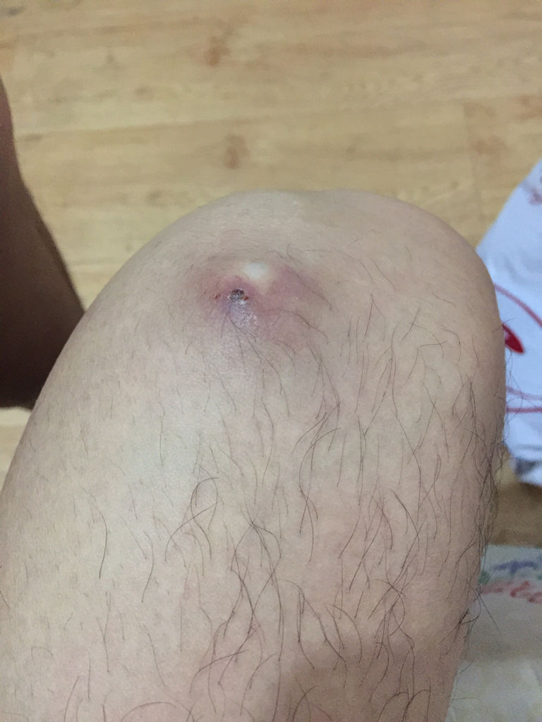 痘痘長(zhǎng)不出來(lái)，肉里硬硬的，原因解析與應(yīng)對(duì)建議，痘痘無(wú)法冒出表面，內(nèi)部硬結(jié)成因解析及應(yīng)對(duì)之策