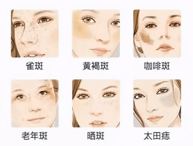 黃褐斑與曬斑的區(qū)別，深入了解兩種常見皮膚問題的差異，黃褐斑與曬斑的深入解析，兩種常見皮膚問題的差異探究