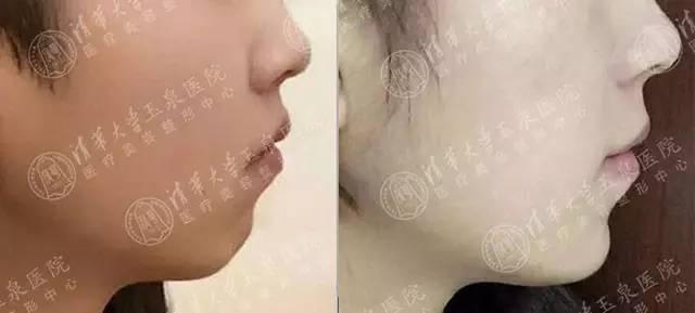 整容下頜骨大概需要多少錢——全面解析費(fèi)用因素與選擇策略，整容下頜骨費(fèi)用全面解析，費(fèi)用因素與選擇策略指南