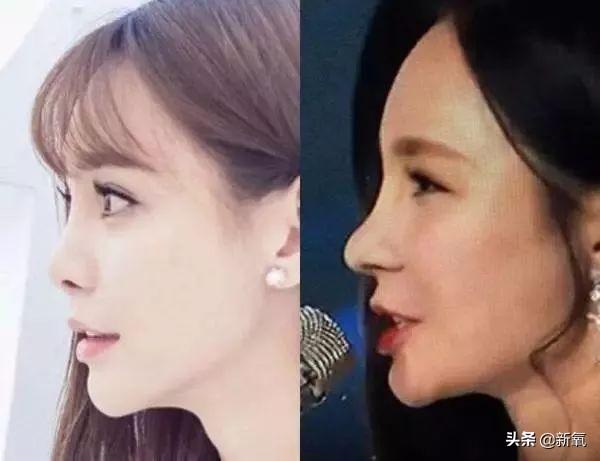 縮小鼻翼手術的風險評估及注意事項，縮小鼻翼手術的風險評估與注意事項詳解